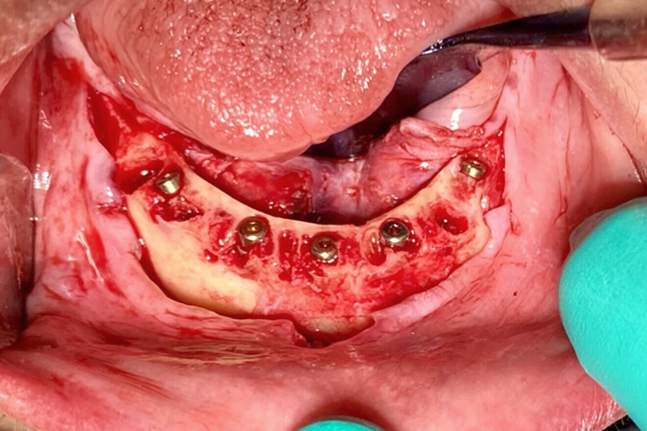 Fig. 14: Five implants placed as planned.