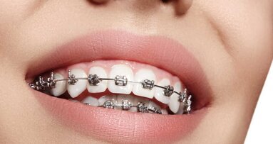 Un adhesivo que evita las caries en los brackets