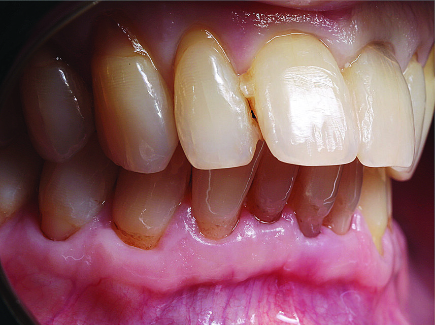 Slika 4. Splintiranje s pomoću udlage od PMMA-e palatinalne strane