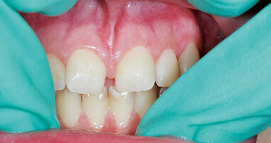 Léčba diastematu v horní čelisti: Úvod a povaha problematiky