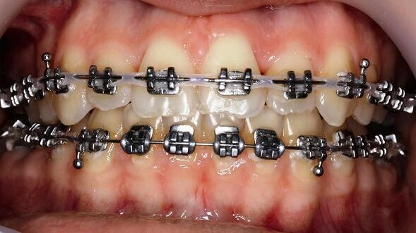 Aesthetics and function: Orthodontic–surgical collaboration as a key to success