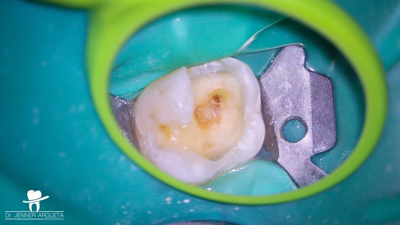 Fig. 4: Pulp tissue haemorrhaging stopped after disinfection with sodium hypochlorite.