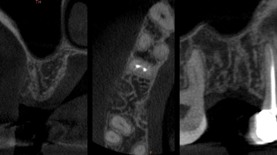 Figg. 7a, 7b - CBCT dopo Inibizione Periostale Modificata.