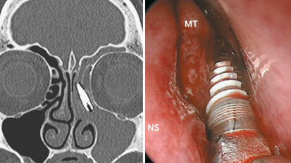 Scoperto un impianto nella cavità nasale di un paziente
