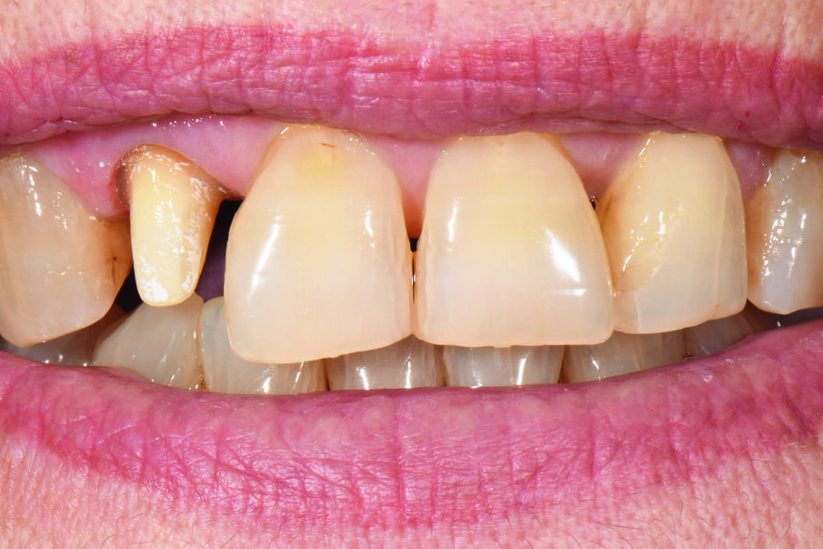 Fig. 2: For the raw and stain try-ins, the temporary was removed.