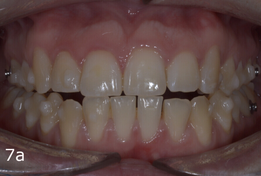 Figs. 7a–f: Situation after aligner set 28. The diastemas distal to teeth #23, 33 and 43 were to be used to retract the anterior teeth.