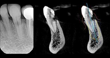 Riassorbimento radicolare esterno trattato con Socket-Shield Technique. Studio del matching degli STL e conferme volumetriche sui pattern di guarigione