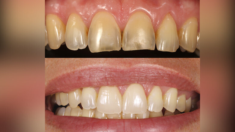 Tratamiento mínimamente invasivo con carillas de cerámica híbrida