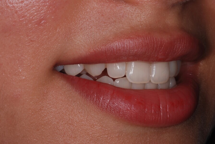 Fig. 8: Smile right side view after treatment.