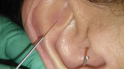 Agopuntura nel trattamento della SLA: implicazioni sistemiche e oro-faringee