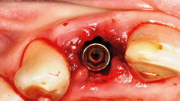 Impianto post-estrattivo  in zona estetica. Le chiavi per un successo predicibile e stabile nel tempo