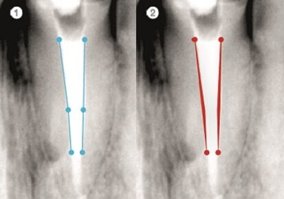 VDW Double Taper Form