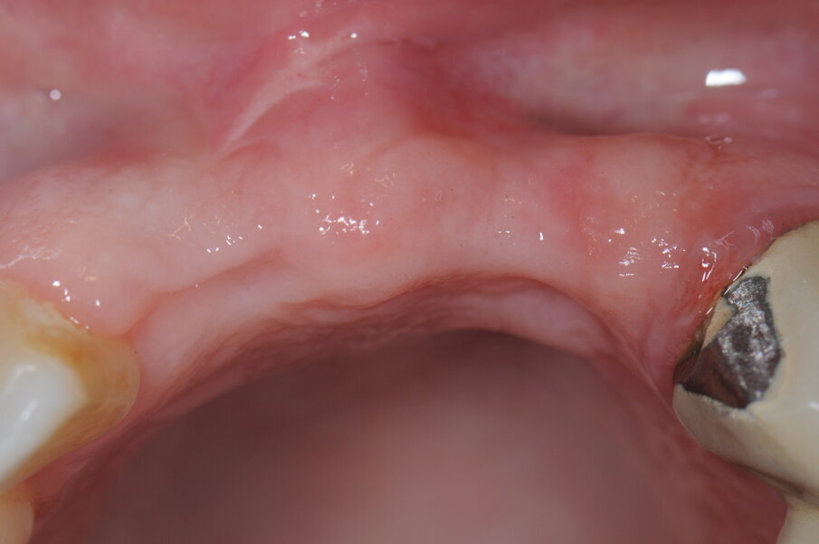 Fig. 6 - Visione occlusale dopo avulsione elemento 1.1.