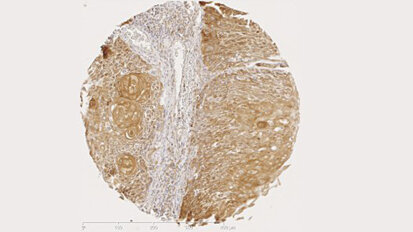 Marker für Krebsverlauf im Mund- und Rachenraum entdeckt