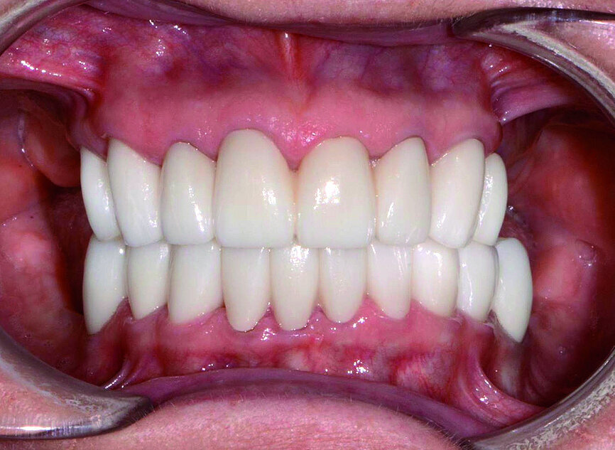 Fig. 11: Seated maxillary and mandibular restorations on teeth.