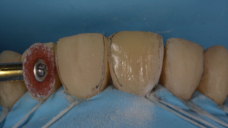 Het intermediair resultaat na opvullen van de buccale vlakken. Voor het afwerken en polijsten werd gebruik gemaakt van het Essential Shape protocol ontworpen door Style Italiano.