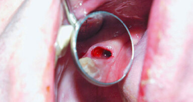 Atraumatické extrakce s Luxator Periotome