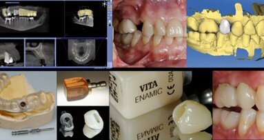 Experte beleuchtet Aufwand und Nutzen der integrierten Implantologie