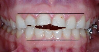 Maloccluzia asociată cu controlul deficitar al posturii și echilibrului