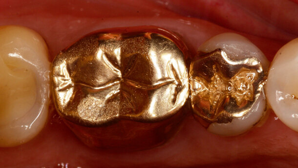 IPS Empress CAD and IPS e.max CAD LT offer aesthetics and strength