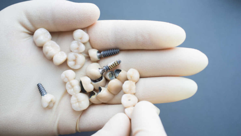 Pesquisadores alemães desenvolvem material de alta resistência para coroa dentária