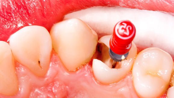 Дентални пациенти получават 35 млн. долара компенсация