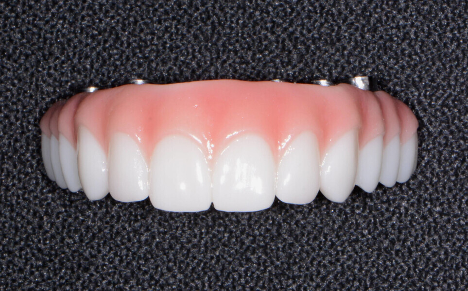 Fig. 15: Definitive hybrid restoration.