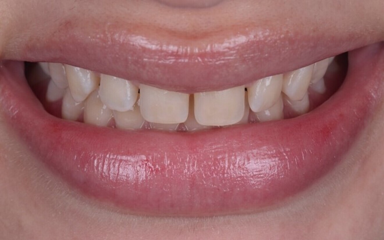 Fig. 2a: Patient smile before treatment.