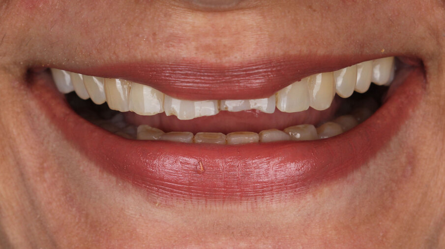 Fig 4: Initial smile