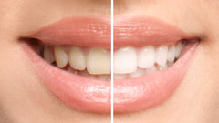 Beyond cosmetics to care: Biocompatible tooth whitening