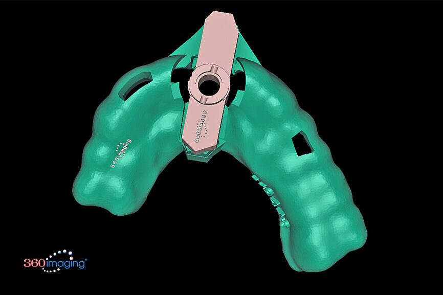 Fig. 15c: Separate inserts were fabricated for the initial drill guide to reach the root apex to accommodate sectioning, followed by a second guide for final osteotomy drilling and implant placement.