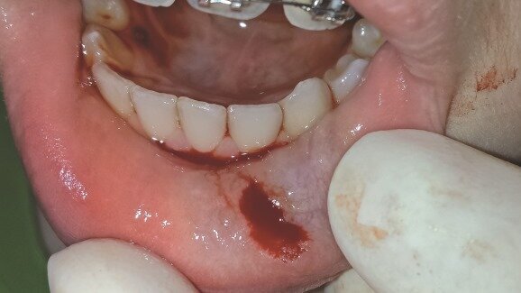 Leczenie mucoceli laserem the Er:YAG – opis przypadku