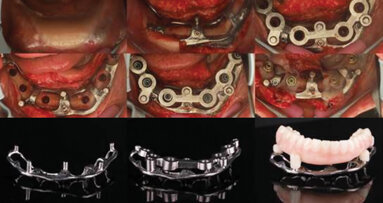 Drs. Cory Glenn and Danny Domingue now offering in-person courses on full-arch surgical guide design