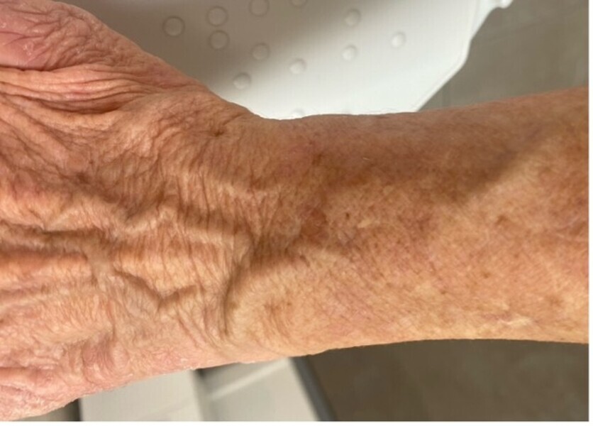 Fig. 7 : Disparition des signes dermatologiques seulement une semaine après le retrait du complexe implanto-prothétique suspect. Il y a dans ce cas une réelle relation de cause à effet entre le complexe implanto-prothétique et les manifestations cutanées.