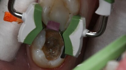 Garrison Dental Composi-Tight 3D Fusion System