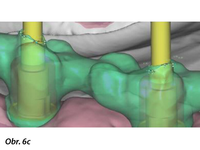 CAD návrh základní konstrukce provizorní fixní náhrady (a) a zvětšené snímky rozhraní mezi CAD základní konstrukcí a prefabrikovanými titanovými abutmenty (b, c).