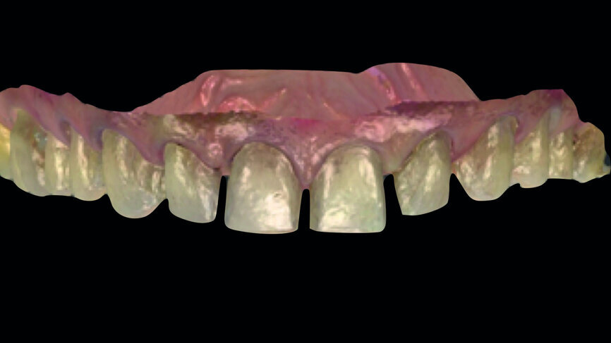 Fig. 11: Digital impression
with TRIOS.