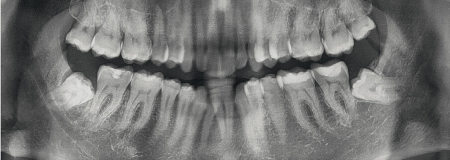 Fig. 10_Radiografia panoramica pre-trattamento.