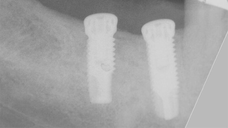 Horizontální augmentace