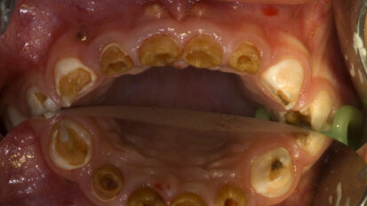 Narkose bei schwerer Kinderkaries wieder planbar