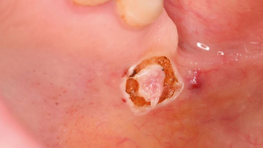 Fig. 2 - Delimitazione della lesione con laser 532 nm, per essere sicuri di non danneggiare il reperto.