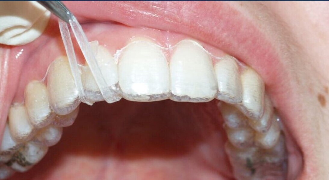 Fig. 5: Intra-arch elastic–button technique.