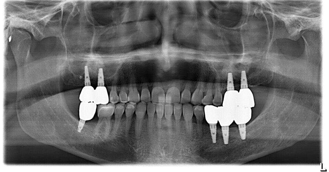 Fig. 23a: Check-up after three years. Dental panoramic tomogram. 