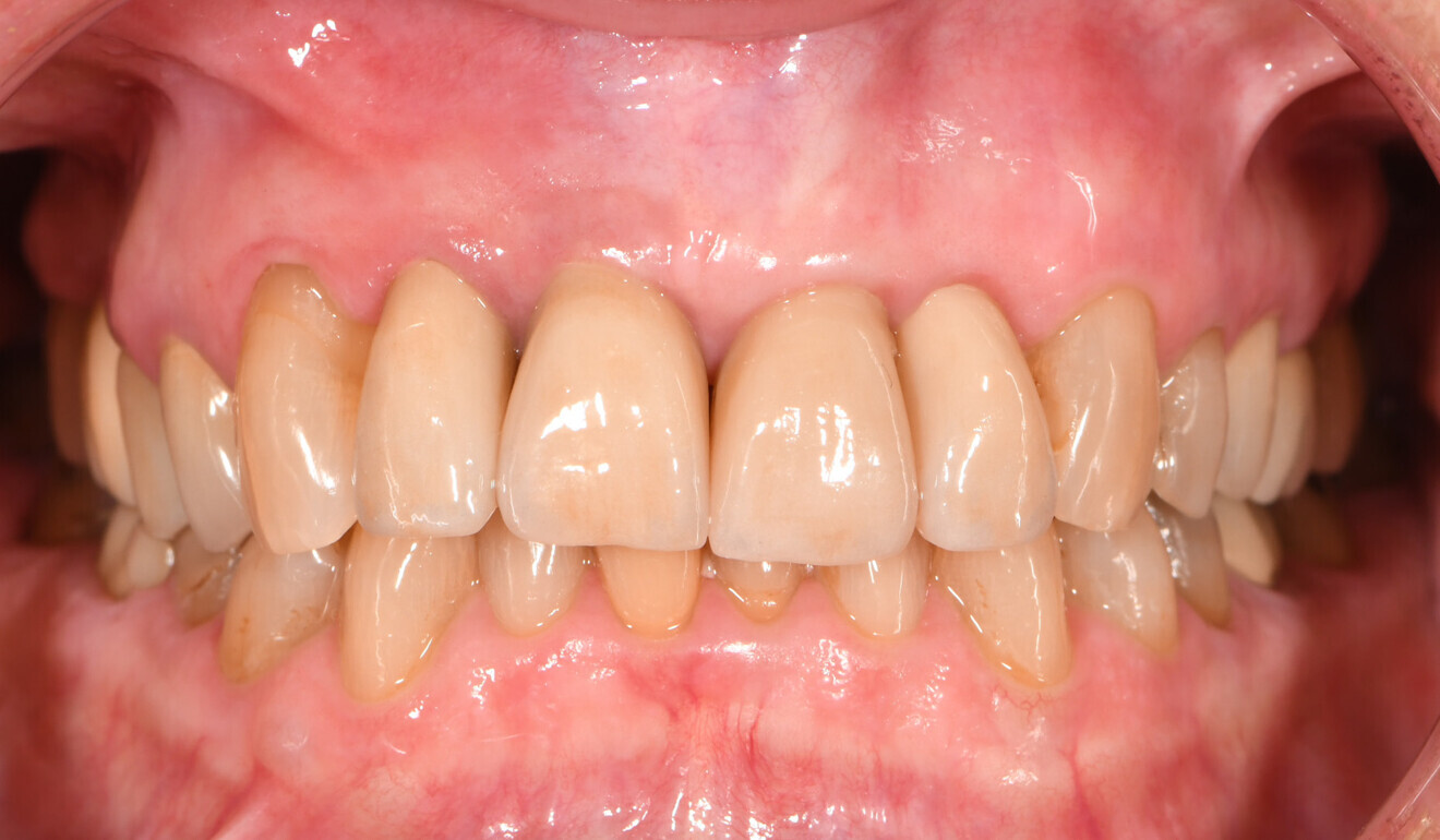 Fig. 14: Immediate treatment outcome, frontal view.