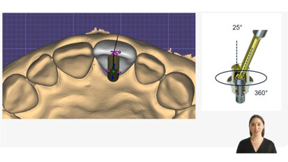 Keystone Dental Group – Conical Connection – Angle Correction Solutions with ANGLEBase and exocad