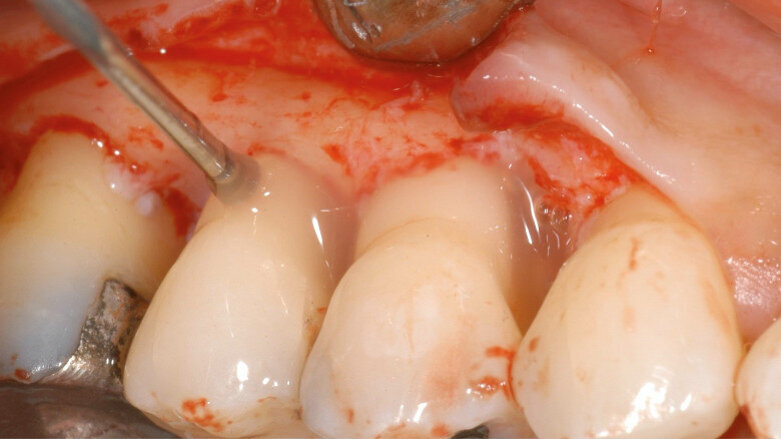 Ist gesteuerte Geweberegeneration ohne Inzision möglich?