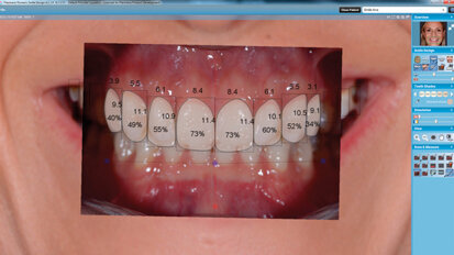 Applicazione di un software per smile design e CAD/CAM per la realizzazione del mock-up e dei restauri definitivi