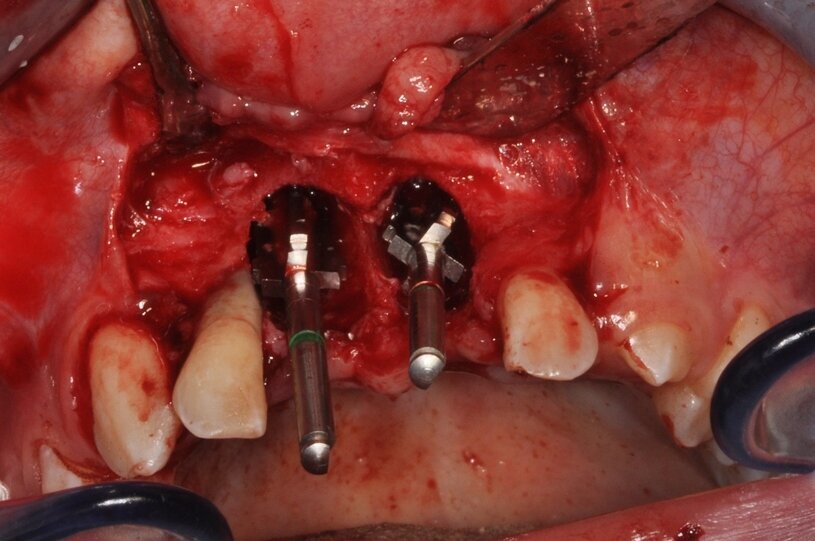 Ryc. 9_Miejsce biorcze po wytworzeniu łoża.