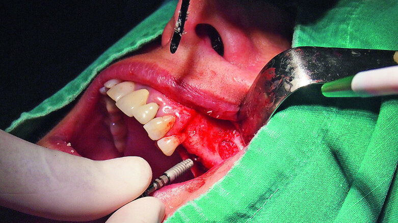 Biomechanical considerations in solving demanding cases