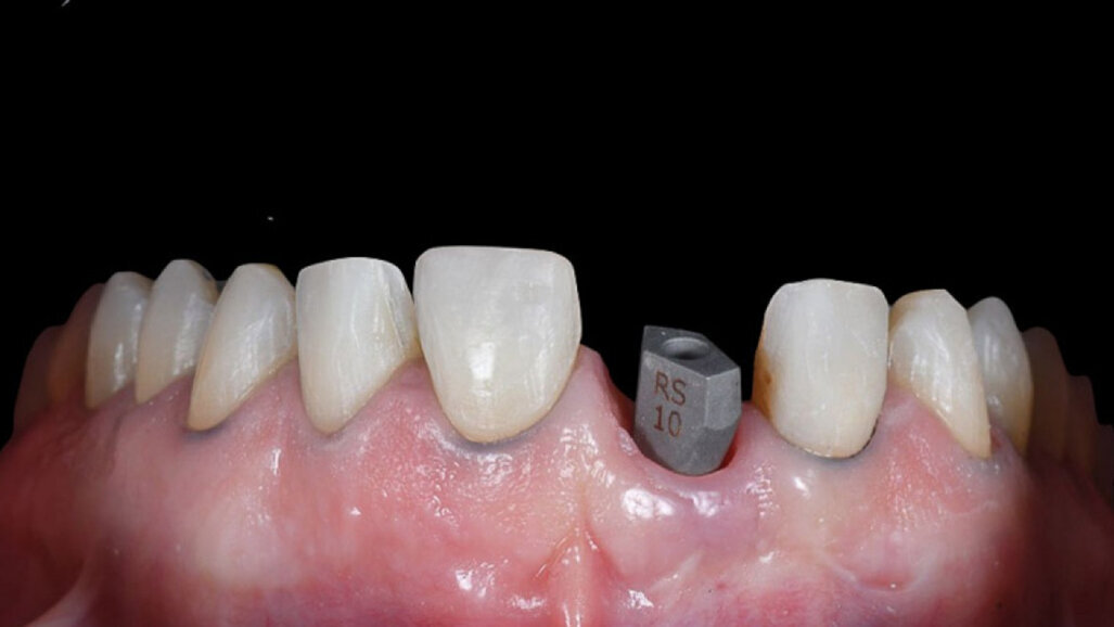 De Invisalign Smile Architect-software maakt het combineren van orthodontische en restauratieve behandelplannen mogelijk